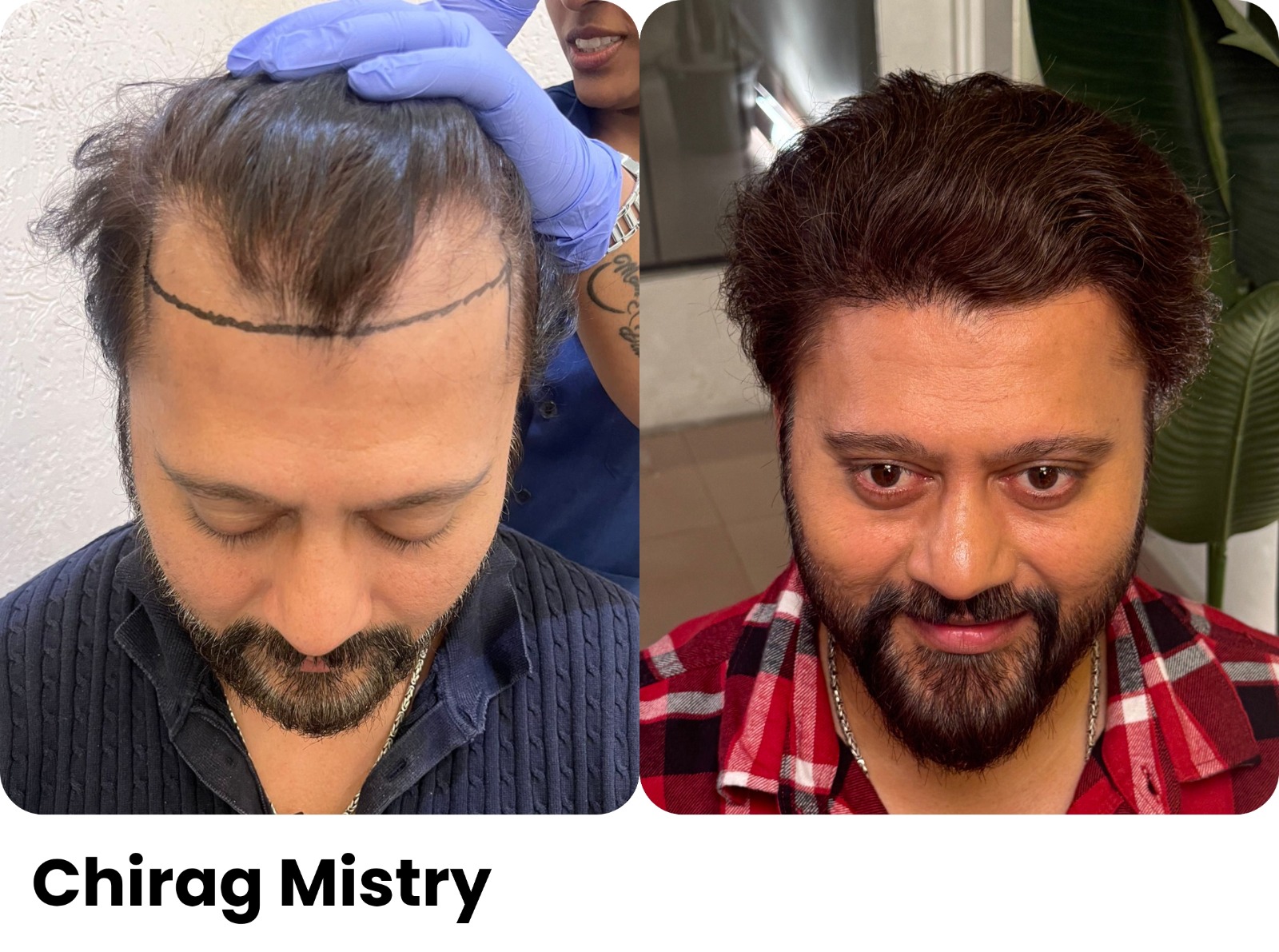 Before and after hair transplant, Chirag Mistry, Assure Clinic patient