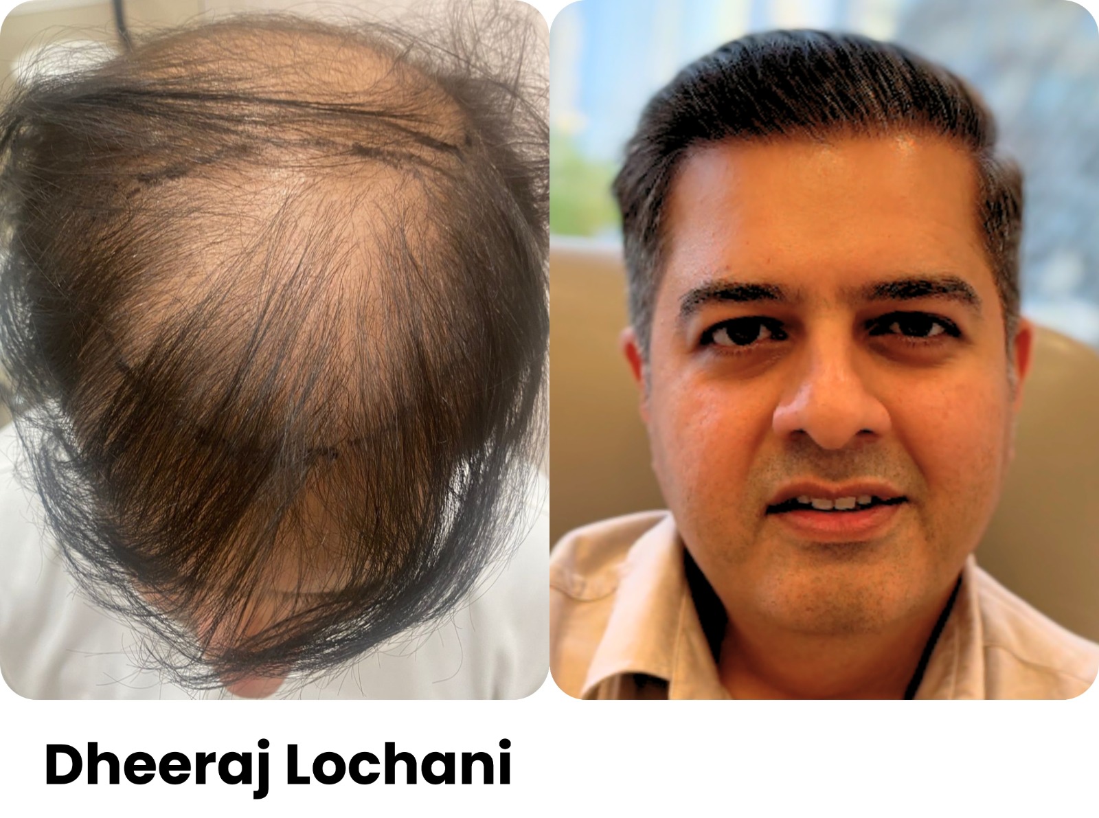Before and after hair transplant, Dheeraj Lochani, Assure Clinic patient
