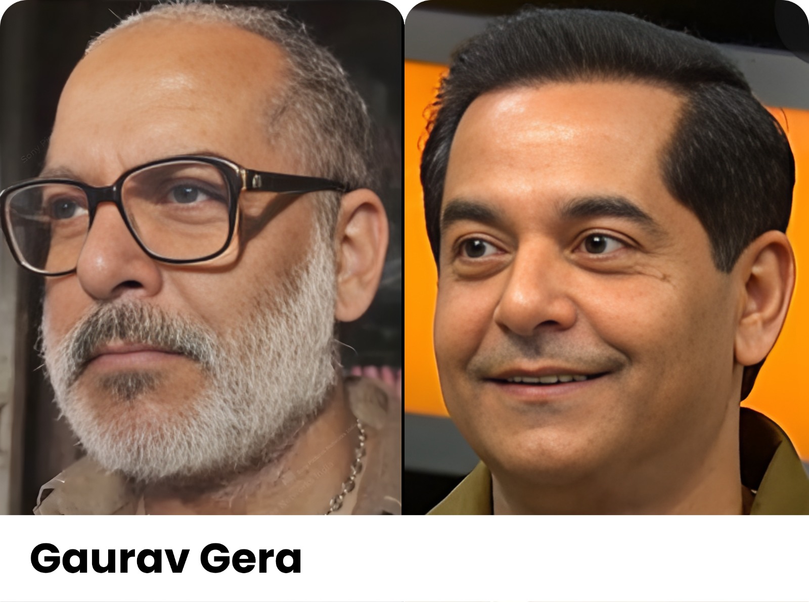 Before and after hair transplant, Gaurav Gera, Assure Clinic patient
