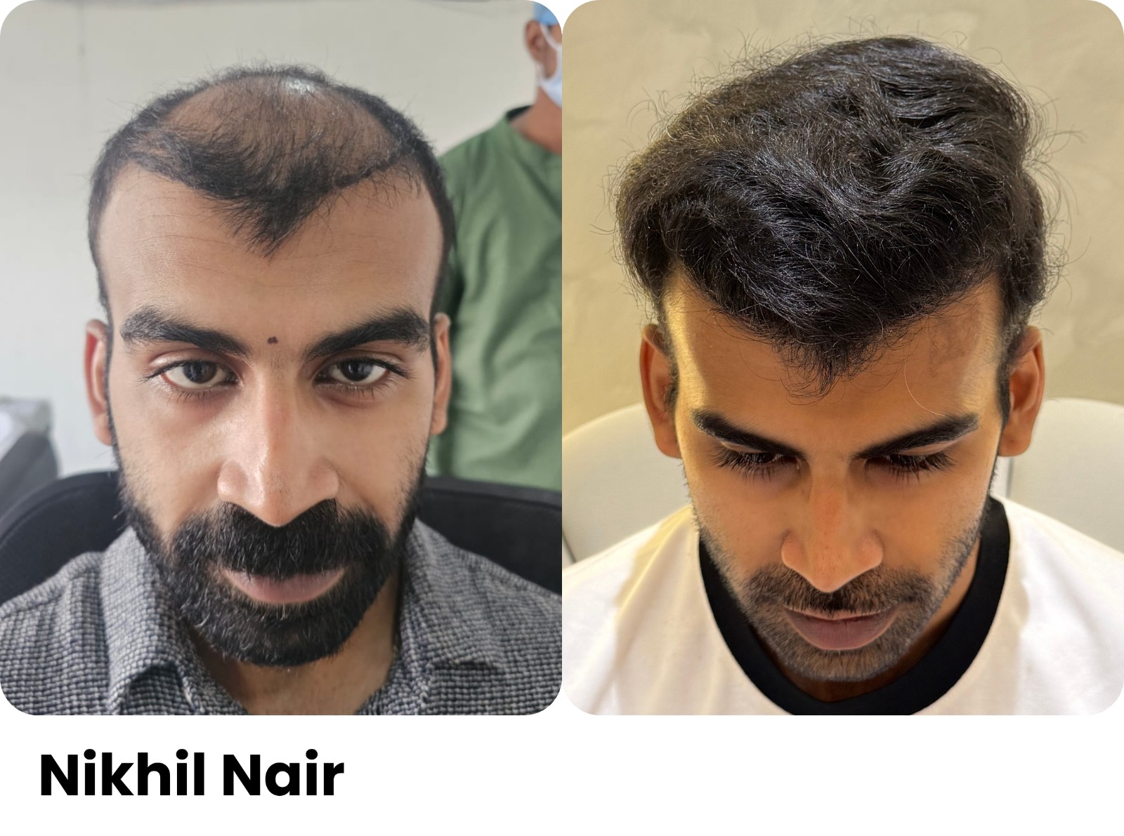 Before and after hair transplant, Nikhil Nair, Assure Clinic patient