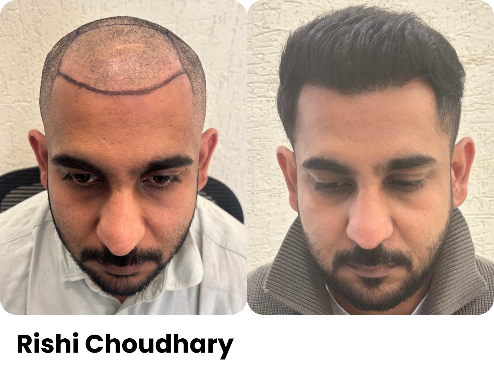 Before and after hair transplant, Rishi Choudhary, Assure Clinic patient