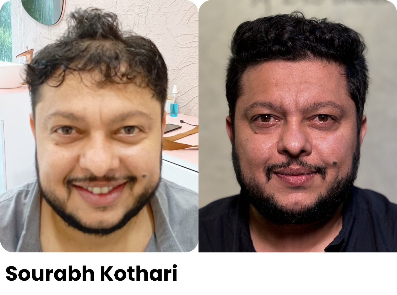 Before and after hair transplant, Sourabh Kothari, Assure Clinic patient